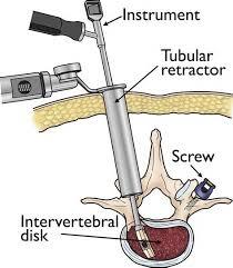 Keyhole surgery