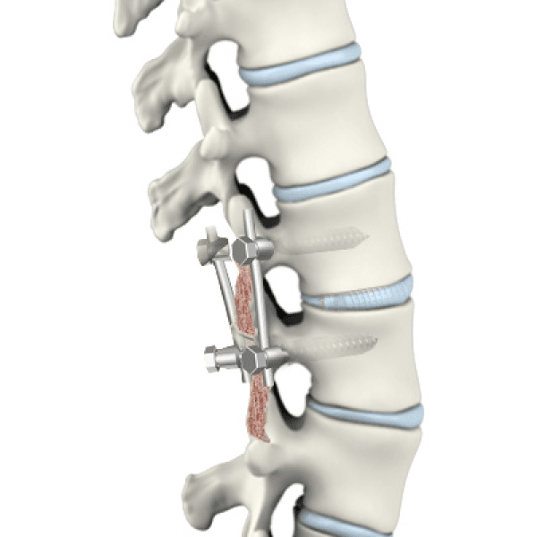 Minimally Invasive TLIF Surgery