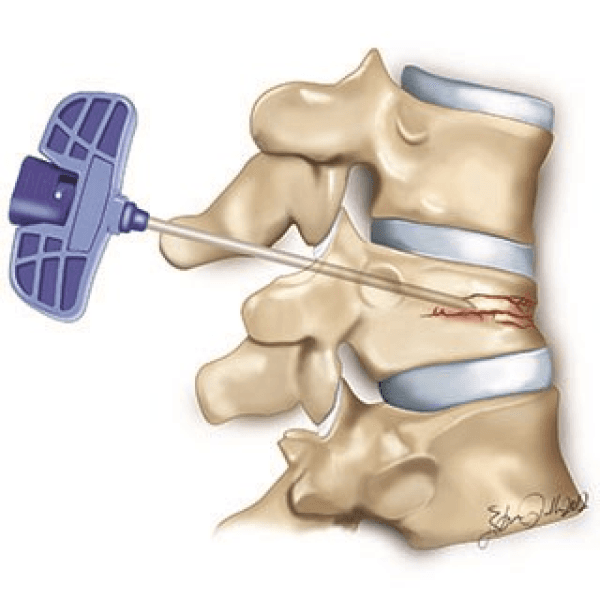 Vertebroplasty Surgery in Hyderabad