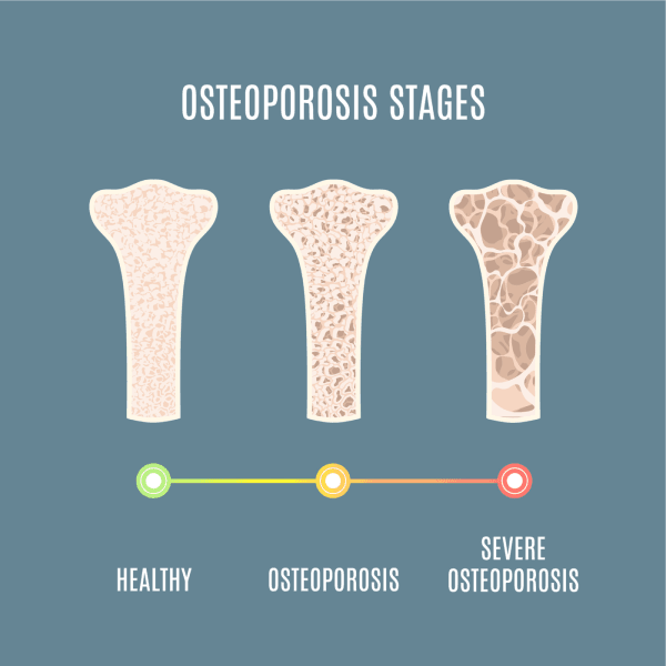 Osteoporosis 