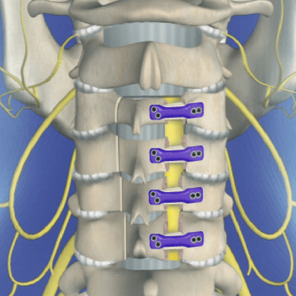 Laminectomy Surgery in Hyderabad