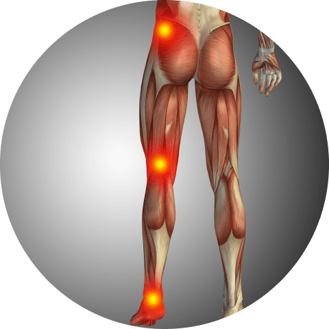 Sciatica