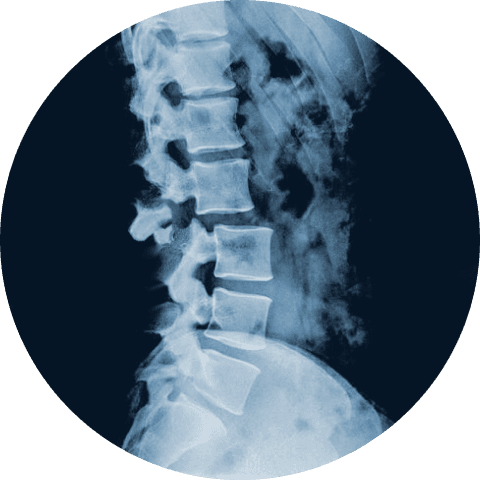 Spinal Fractures