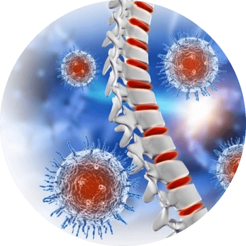 Spondylodiscitis Spinal Infection