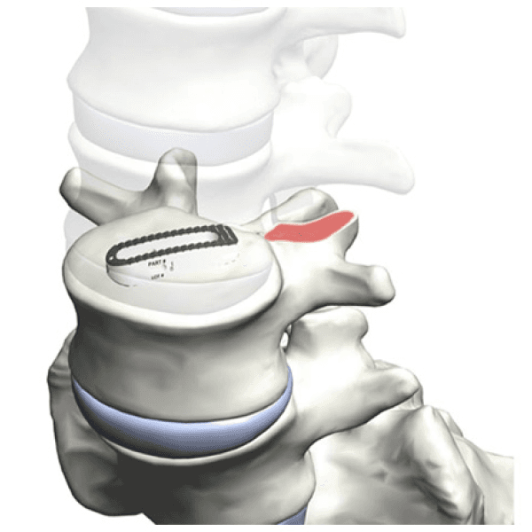 OLIF Surgery in Hyderabad