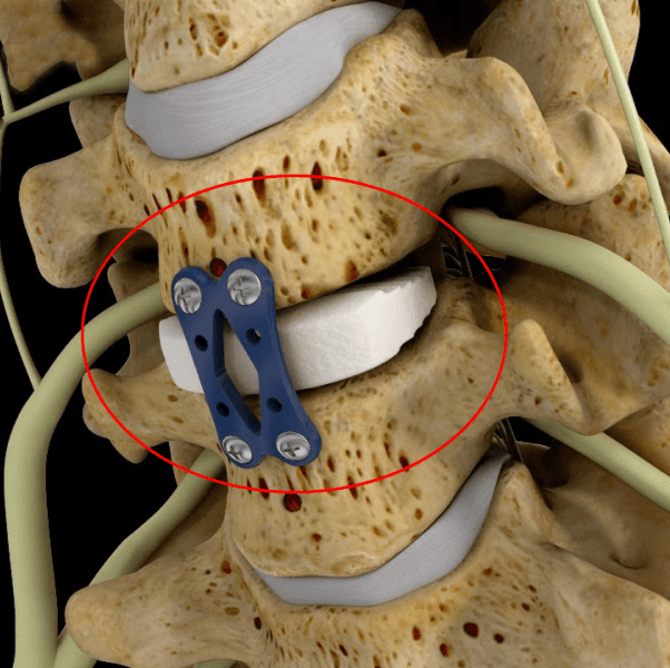 ACDF Surgery in Hyderabad