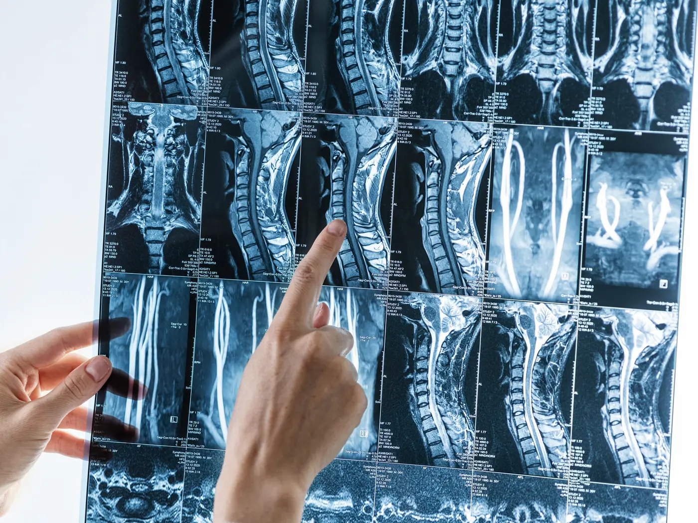 Cervical spine surgeries