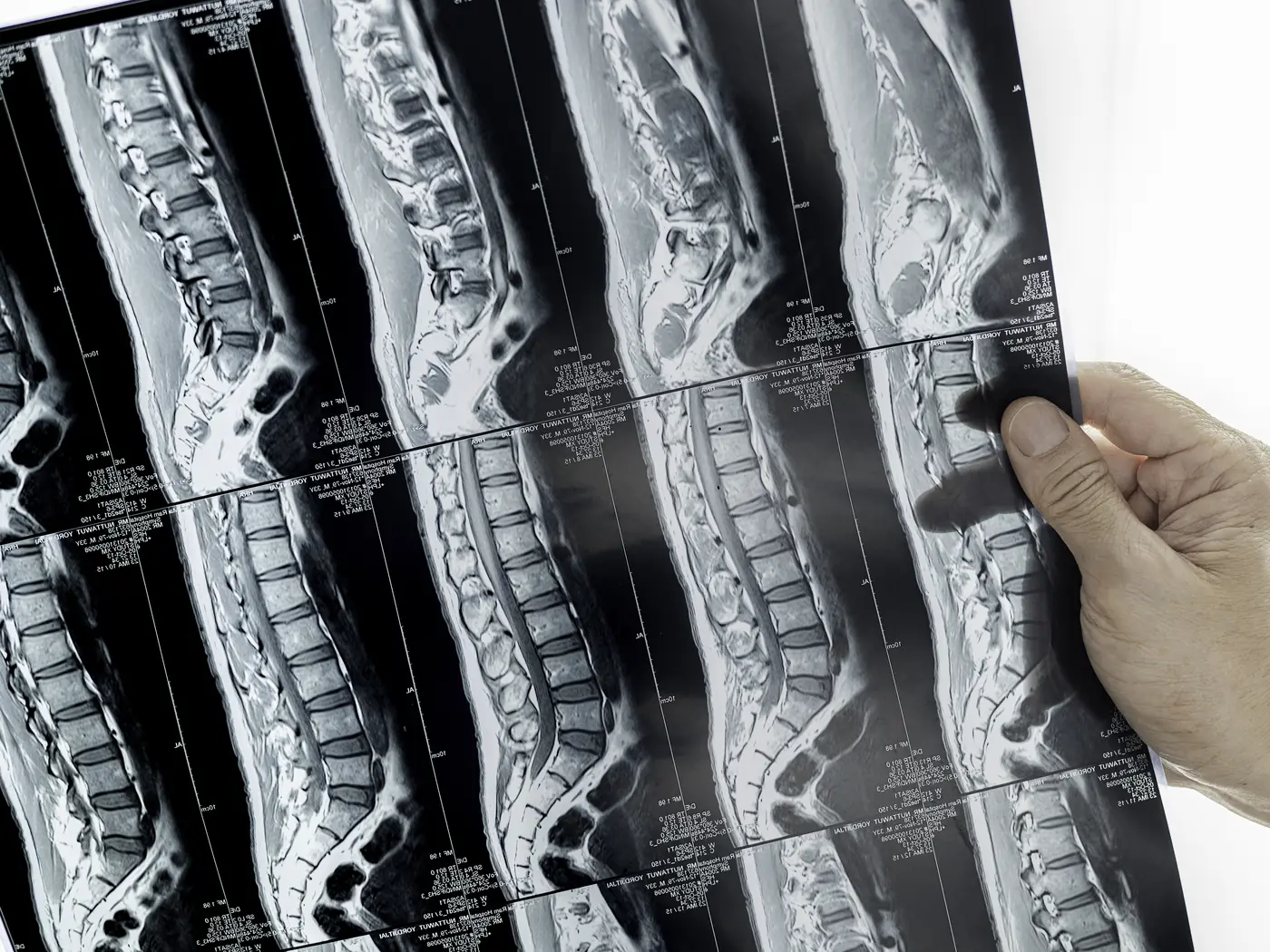 Lumbar and cervical disc surgeries