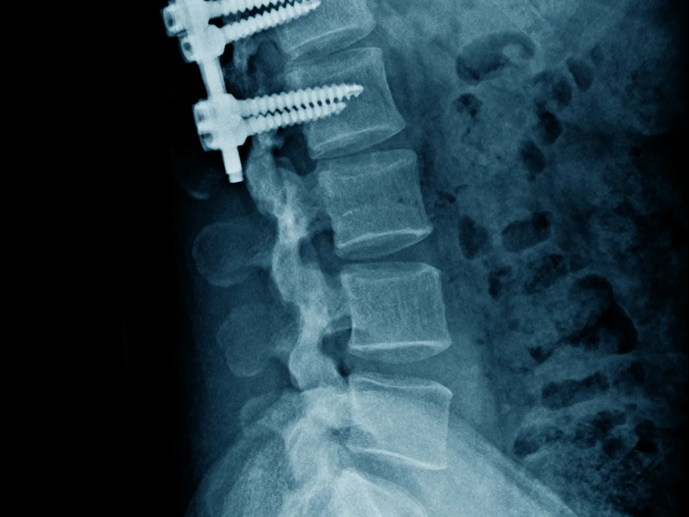 Revision spine surgeries