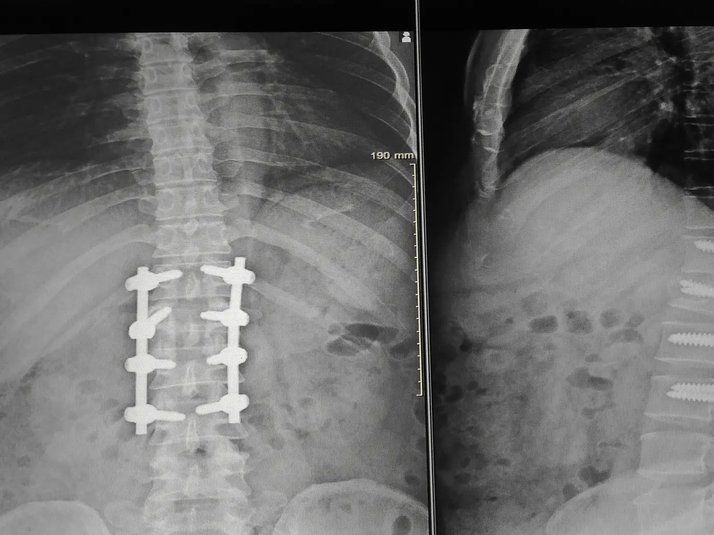 Spinal fusion surgeries