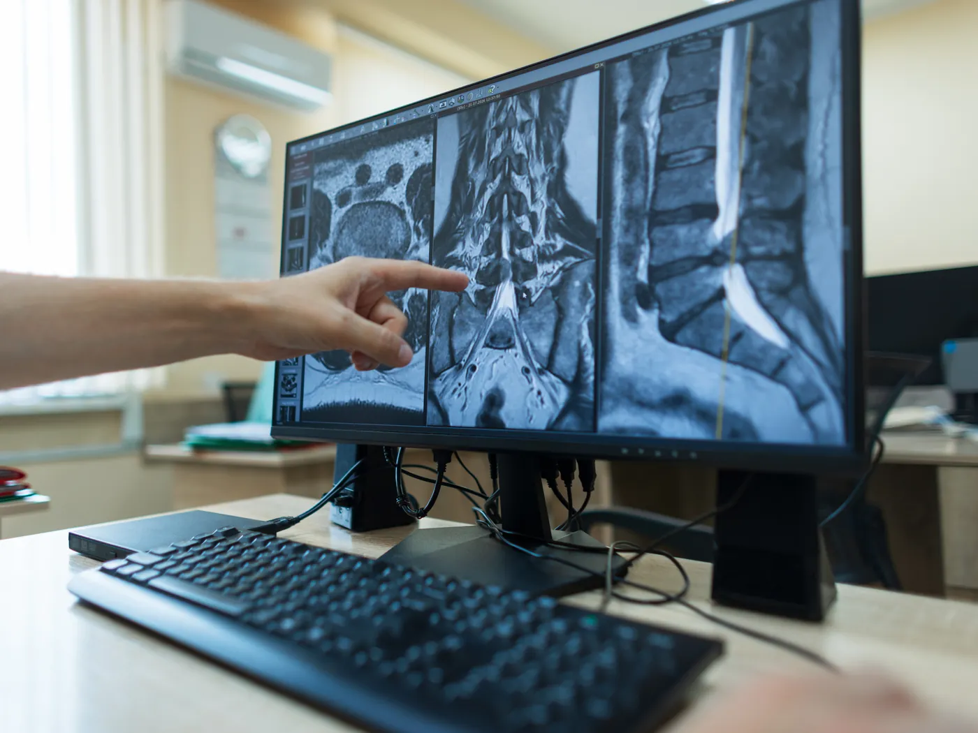 Spinal stenosis (lumbar canal stenosis)