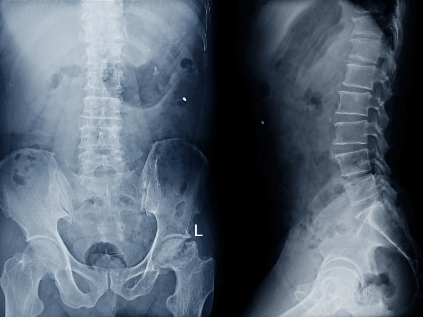 Spine fracture surgeries