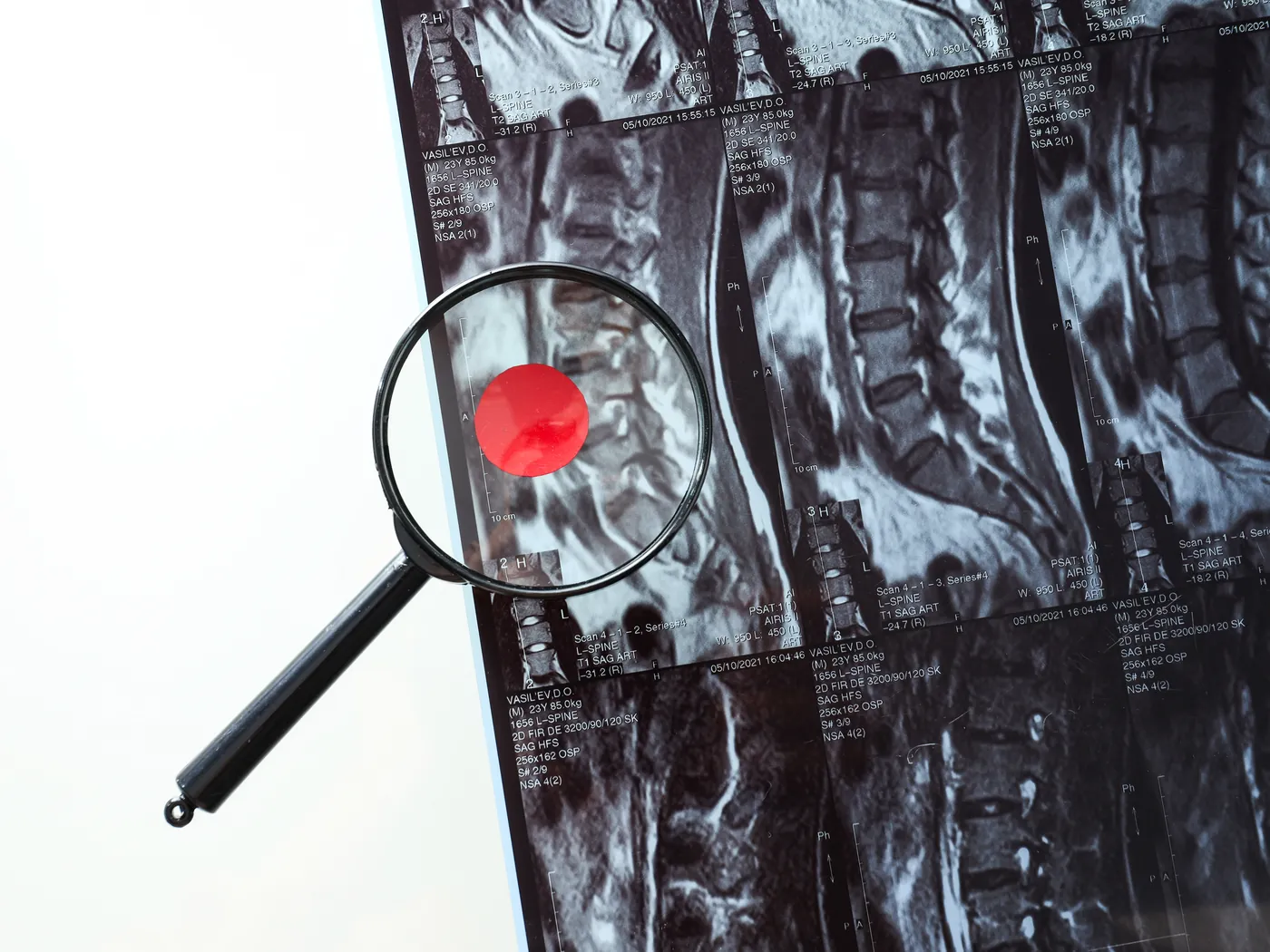 Spine tumours