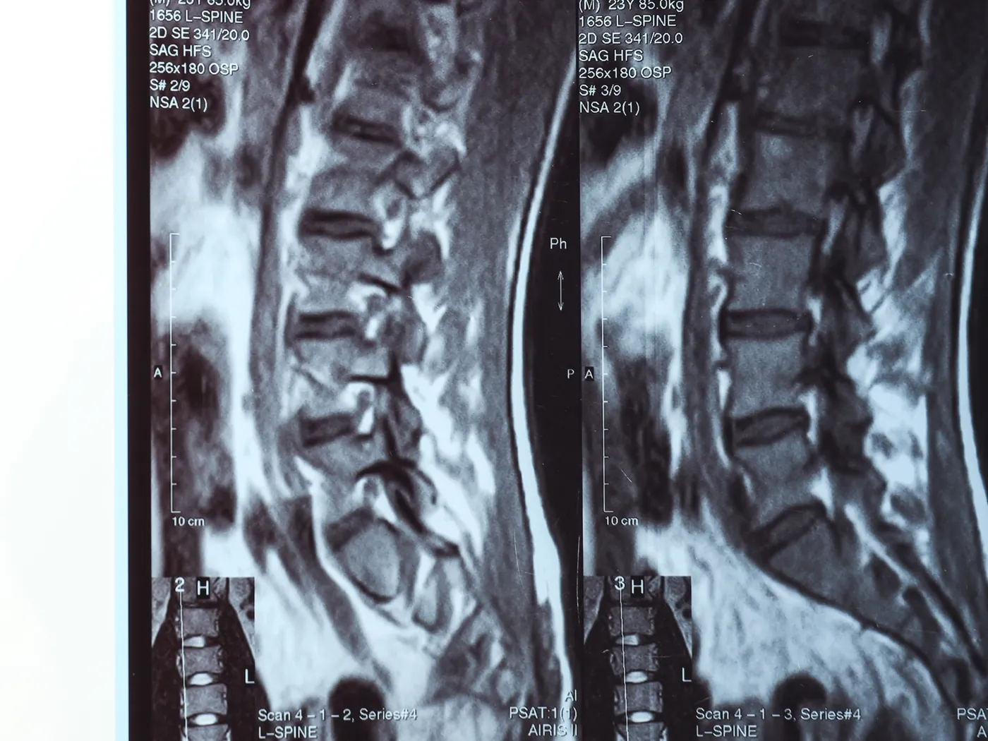 Spondylodiscitis (spinal infection)