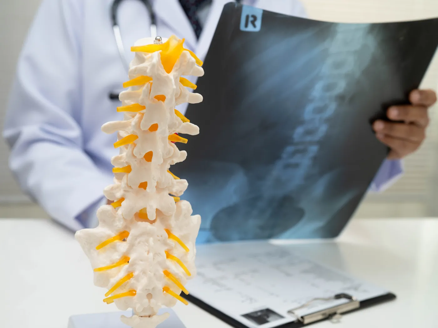 Spondylolisthesis (slipped vertebra)